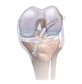ACL Injury - An Medical